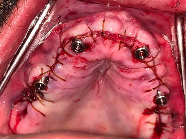 All-on-4 Implants Stitched Up in Mouth