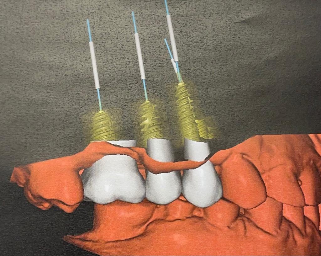 Virtual implant planning screen showing three planned implant positions from CBCT data