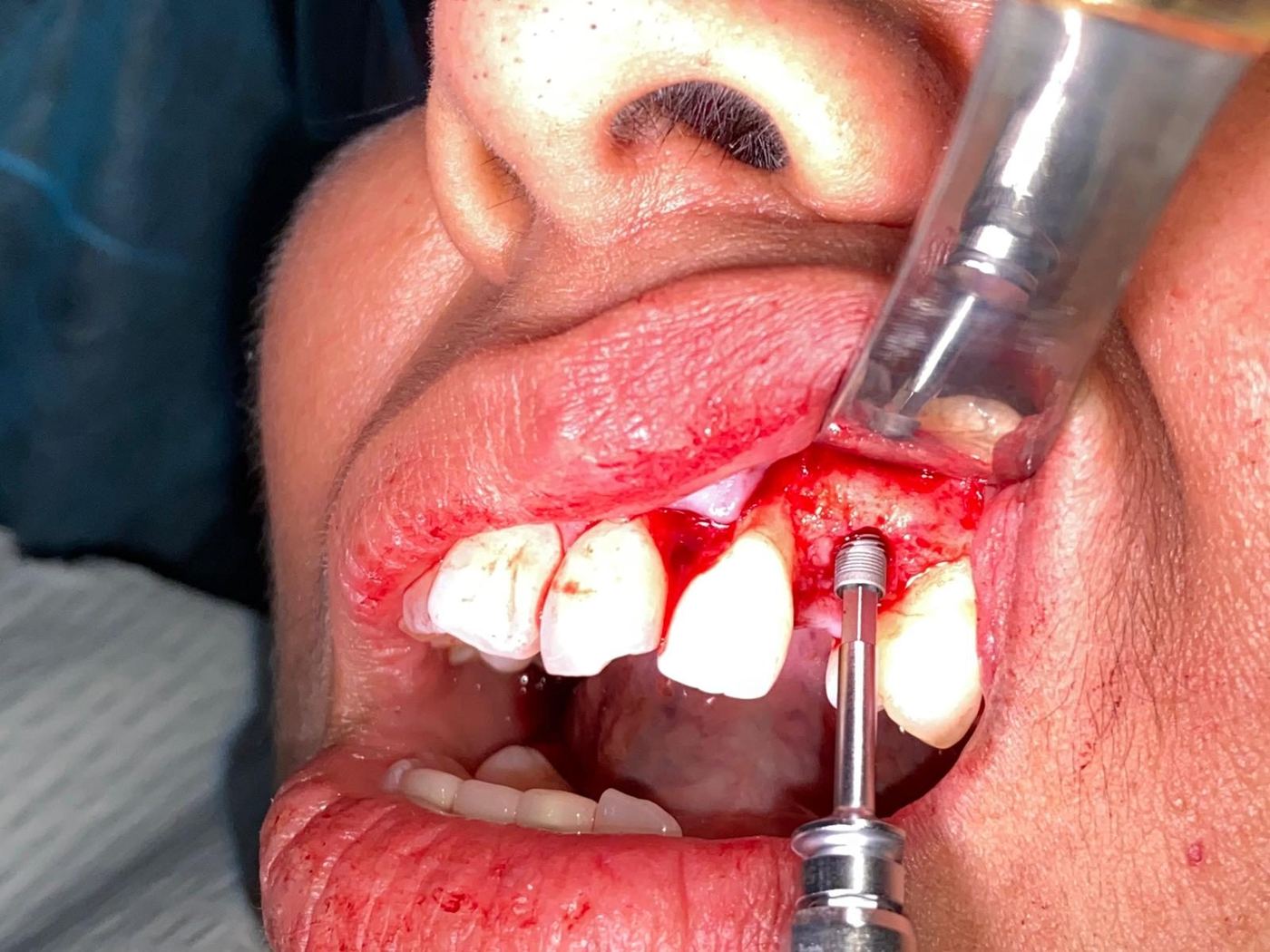 Radiograph of a single implant placed during the live surgical implant course