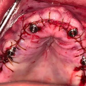All-on-4 Implants Stitched Up in Mouth