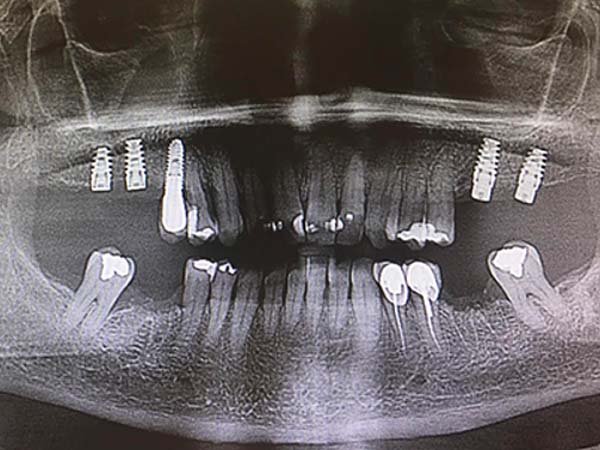 X-Ray of Placed Implants