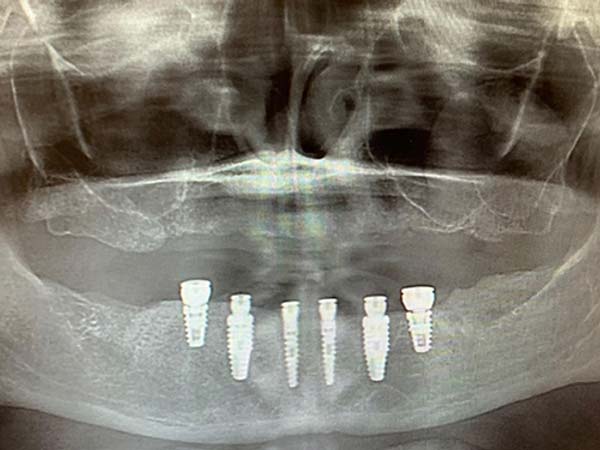 X-Ray of Placed Implants