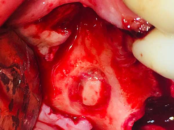 Sinus Lift Prior to Dental Implant