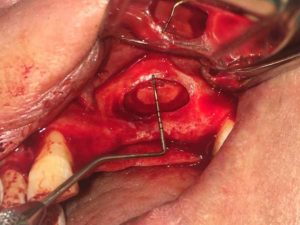 Sinus Lift Training on Live Patient