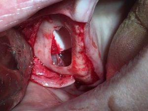 Surgical Sinus Lift Training During Procedure