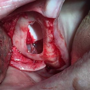 Surgical Sinus Lift Training During Procedure