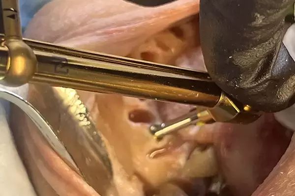 Cadaver Implant Placement